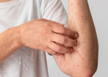 Корь наступает?